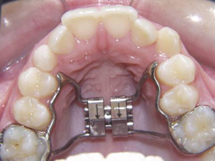 orthodontic palatal expander instructions