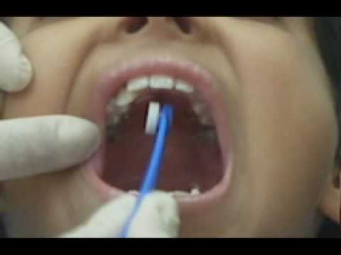 orthodontic palatal expander instructions